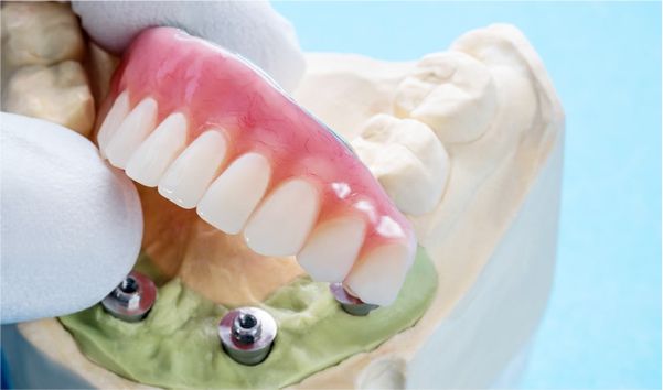 Prótese Fixa e Removível