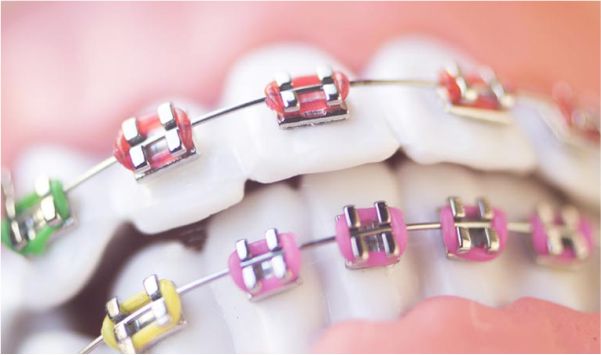 Ortodontia - Correção Dentária